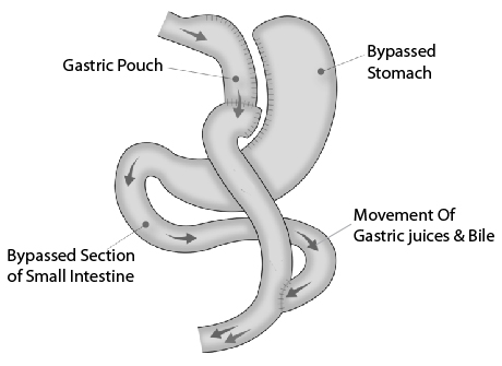 Laparoscopic Roux-en-Y Gastric Bypass Laparoscopic Roux-en-Y Gastric Bypass