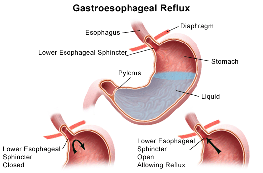 The symptoms of GERD occur as heartburn after eating a large meal, bending over or lying down.